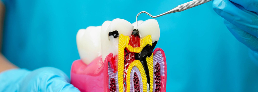 CBCT Imaging for Modern Endodontics Dentist using CBCT digital imaging for accurate root canal diagnosis